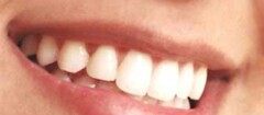 implantes-dentarios-xxxx-1354583445